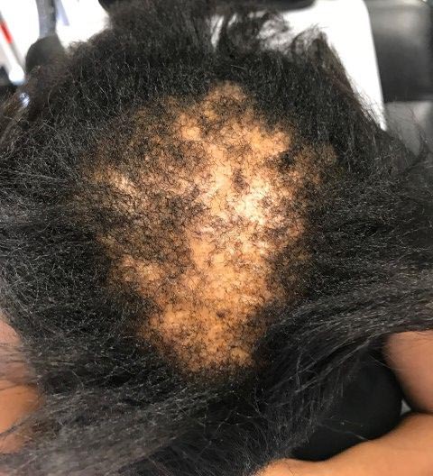 Growing bald spot in the middle of the head due to Alopecia Areata. 