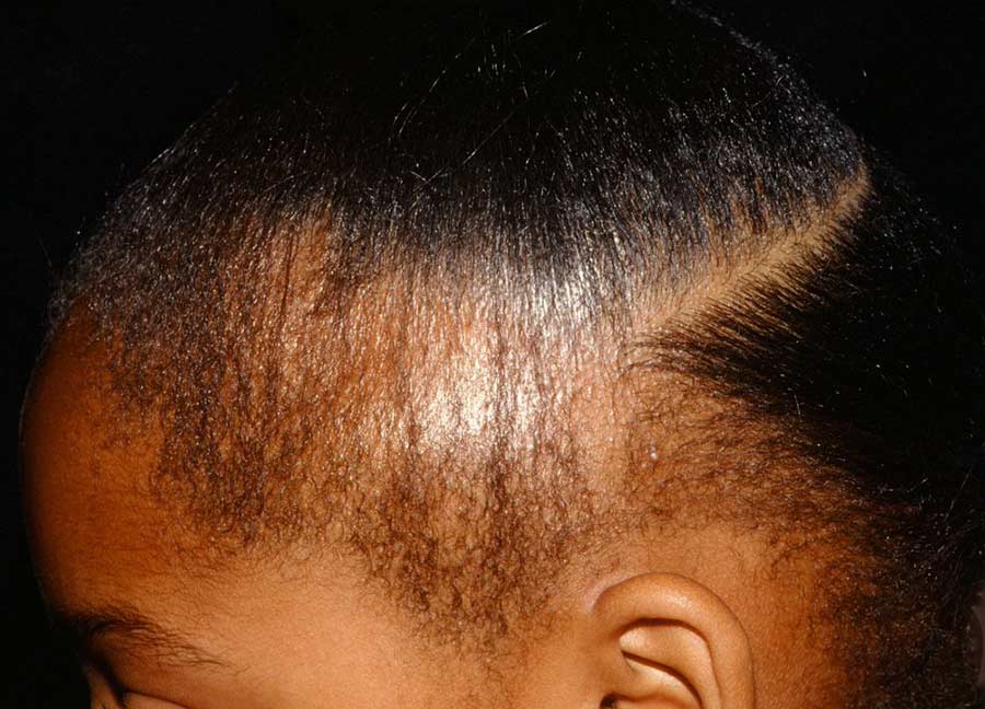 thinning hair on an african lady with natural hair