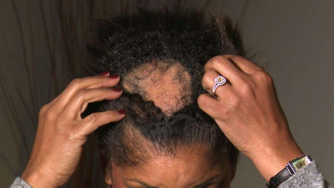 A woman with a bald spot in the middle of her head shows how to regrow hair on bald spots.