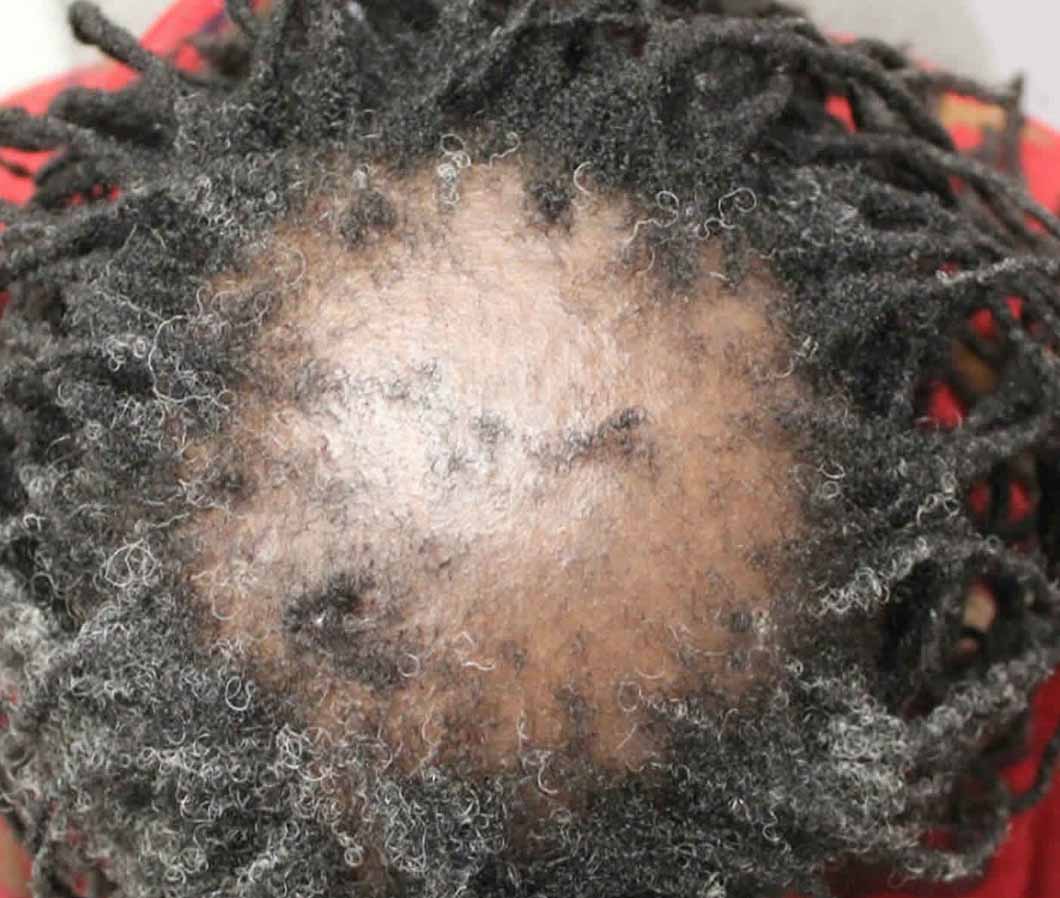 Central centrifugal cicatricial alopecia at the crown of your head
