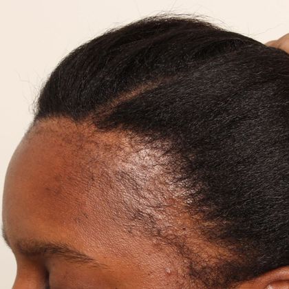 lady with thinning edges all round the crown of her head
